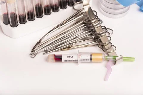 Blood sample with abnormal high PSA test result. Stock Photos