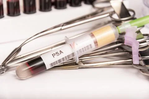 Blood sample with abnormal high PSA test result. Stock Photos