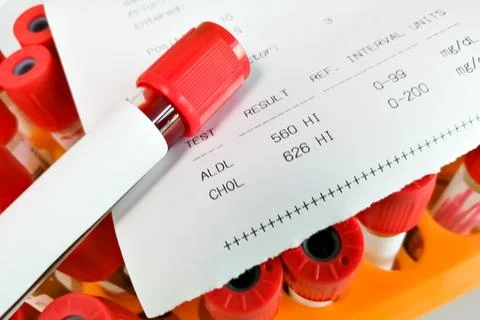 Blood sample with abnormal high report of  Total and LDL Cholesterol 스톡 사진