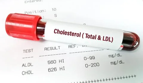 Blood sample with abnormal high report of  Total and LDL Cholesterol 스톡 사진