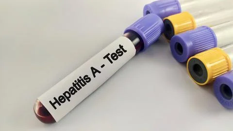 Blood sample for hepatitis A virus test Stock Photos
