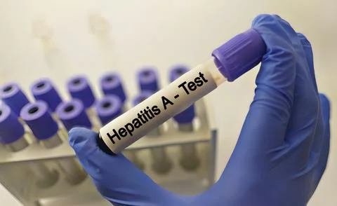 Blood sample for hepatitis A virus test Stock Photos