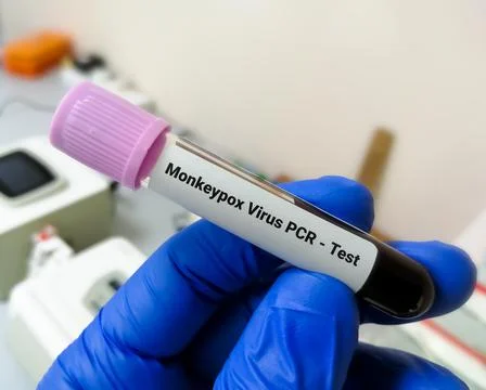 Blood sample for Monkeypox virus PCR test. Foto stock