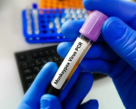 Blood sample for Monkeypox virus PCR test. 스톡 사진