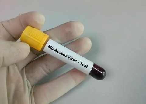 Blood sample for Monkeypox virus test. 스톡 사진