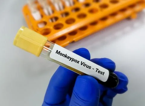 Blood sample for Monkeypox virus test. 스톡 사진