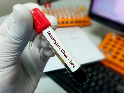 Blood sample for Monkeypox virus test. Foto stock