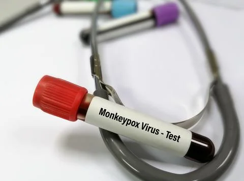 Blood sample for Monkeypox virus test. a double-stranded DNA virus Foto stock
