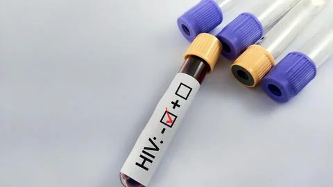 Blood sample negative with HIV testing Stock Photos