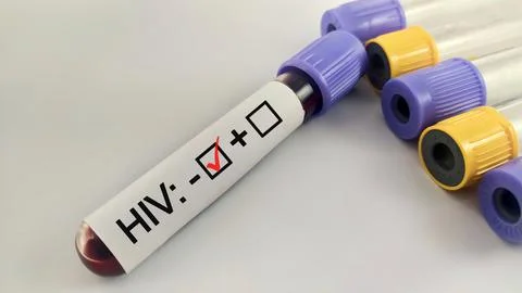 Blood sample negative with HIV testing Stock Photos