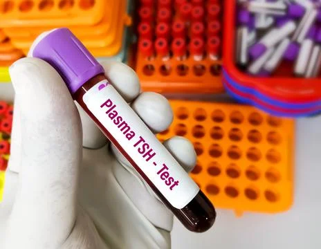 Blood sample for plasma TSH test for thyroid disease diagnosis. Foto stock