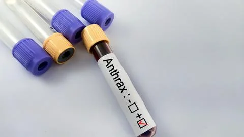 Blood sample positive with anthrax testing Stock Photos