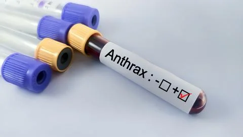 Blood sample positive with anthrax testing Stock Photos