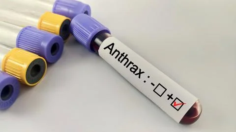 Blood sample positive with anthrax testing Foto stock