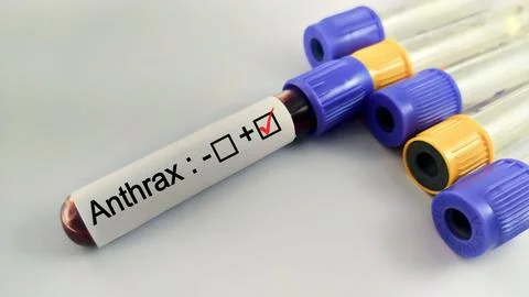 Blood sample positive with anthrax testing Stock Photos