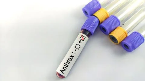 Blood sample positive with anthrax testing Stock Photos
