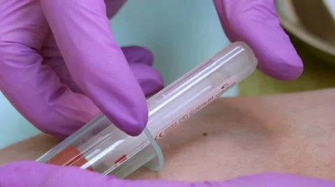 Blood sample from a vein closeup Stock Footage 42885823