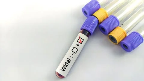 Blood sample for Widal test. Foto stock