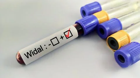 Blood sample for Widal test. Stock Photos