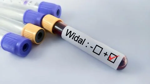 Blood sample for Widal test. Stock Photos