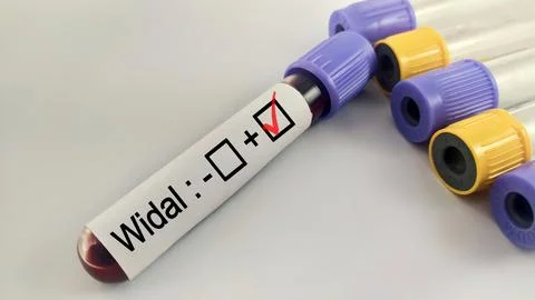 Blood sample for Widal test. Stock Photos