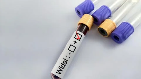 Blood sample for Widal test. Stock Photos
