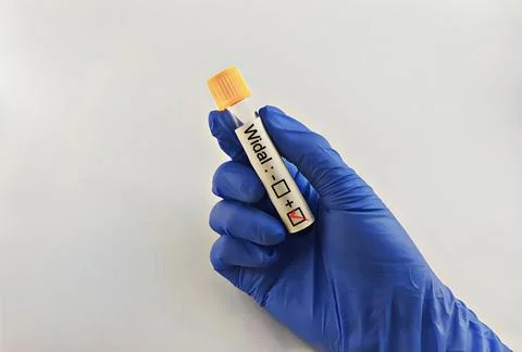 Blood sample for Widal test. Stock Photos