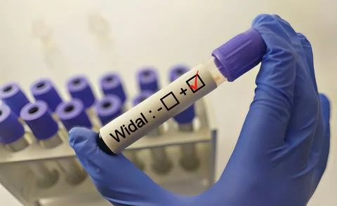Blood sample for Widal test. Stock Photos