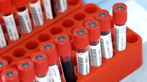 Blood samples in containers. Panoramic shot Video stock 103140573