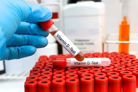 Blood samples for testing vitamin D in the laboratory Stockfoto's