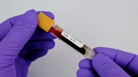 Blood test. Real blood sample with anticoagulant in a tube. Stock Footage 141157726