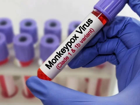 Blood test sample for monkey pox virus (MPXV) test. Stock Footage 292408765