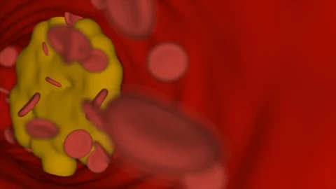 Bloodstream with cholesterol Stock Footage 94623168