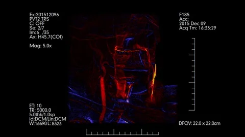 Blue and orange colored brain vessels angiogram.  Cerebral angiography. Stock Footage 89749377