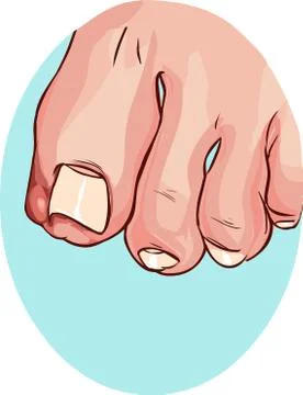 Blue backround Vector illustration of a Ingrown Toenail Illustrazione stock