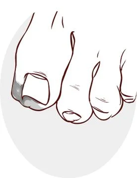 Blue backround Vector illustration of a Ingrown Toenail Stock Illustration