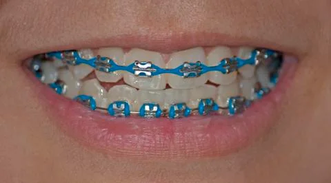 Blue braces Fotos de archivo