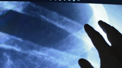 Blue mri scan technology of a man in a hospital. patient mri scan. 스톡 동영상 225499784