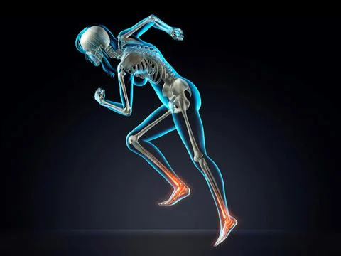 Blue X-ray of woman's skeleton with foot inflammation running on dark blue Stockillustratie