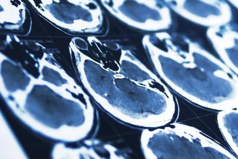 Blurred closeup of brain granular structure, computerized tomography Stock Photos