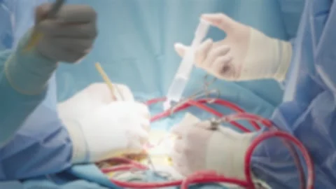 Blurred view, complex heart surgery process, close up of surgeons hands, pro Stock Footage 311507943