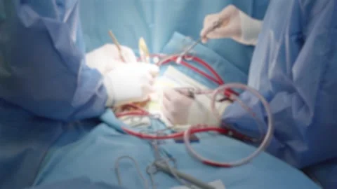 Blurred view, heart complex surgery process, close up of surgeons hands Stock Footage 311503458