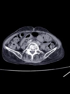 Blurry CT Scan lower abdomen Severe hydronephrosis Rt kidney . Stock Photos