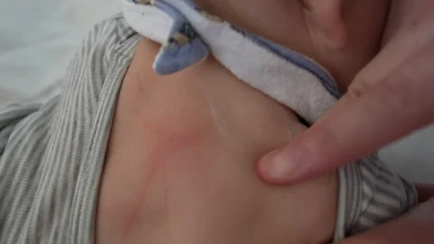 Blurry handheld view of baby's red eczema skin Stock Footage 301367934