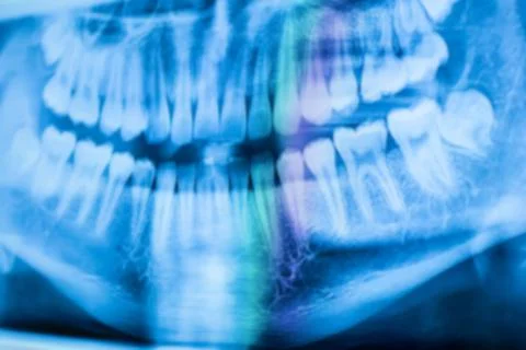 Blurry image for background of X-ray image of a boy's teeth, front view of a  Stock Photos