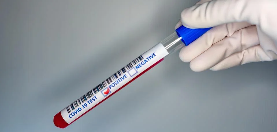 Blurry image of a hand while holding a test tube containing a patients sample Stock Photos