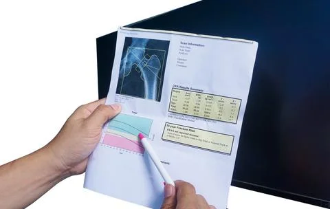 (BMD) DEXA densitometry hip scan. Osteopenia present, frequent precursor to o Stock Photos