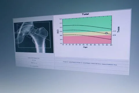 BMD Woman's hip joint bone mass image The graph has a standard point below Th Stock Photos
