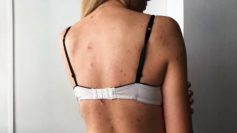 Body Acne Stockbeeldmateriaal 98781047