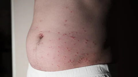 Body acne Stomach pimples Suspected insect bites Potential allergic